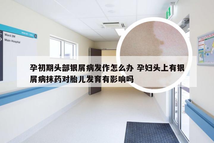 孕初期头部银屑病发作怎么办 孕妇头上有银屑病抹药对胎儿发育有影响吗