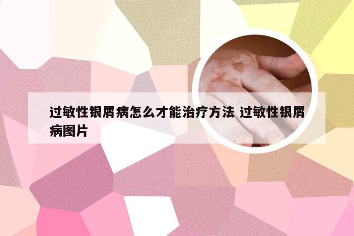 过敏性银屑病怎么才能治疗方法 过敏性银屑病图片