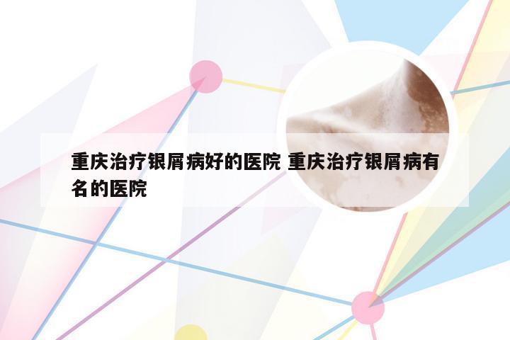 重庆治疗银屑病好的医院 重庆治疗银屑病有名的医院