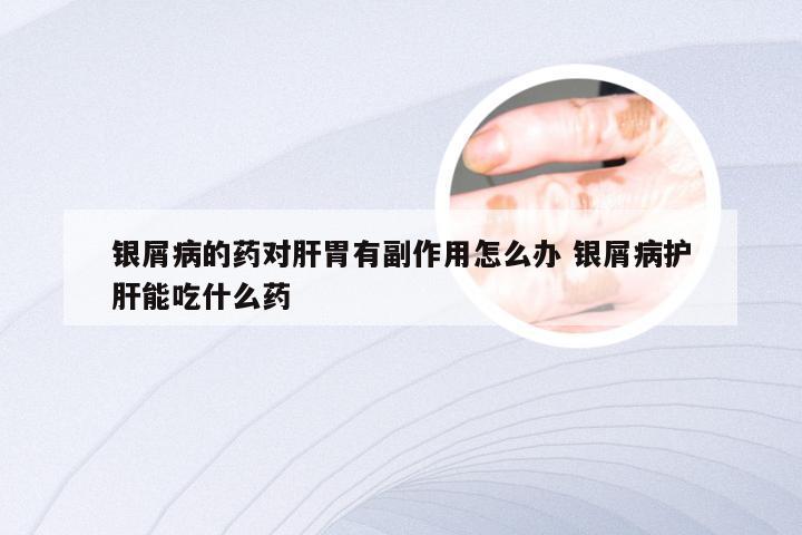 银屑病的药对肝胃有副作用怎么办 银屑病护肝能吃什么药