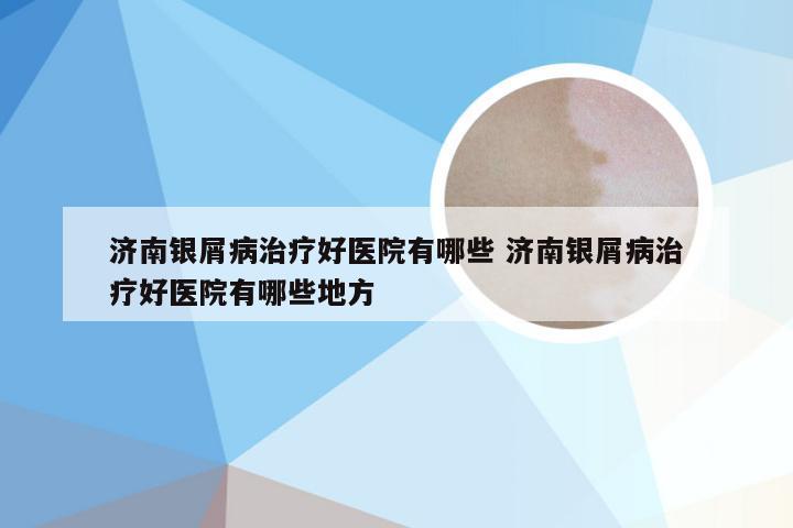 济南银屑病治疗好医院有哪些 济南银屑病治疗好医院有哪些地方