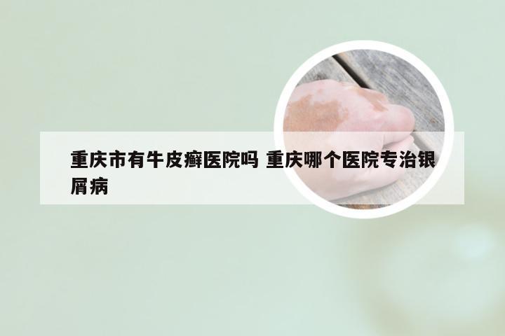 重庆市有牛皮癣医院吗 重庆哪个医院专治银屑病