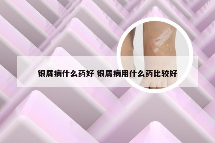 银屑病什么药好 银屑病用什么药比较好