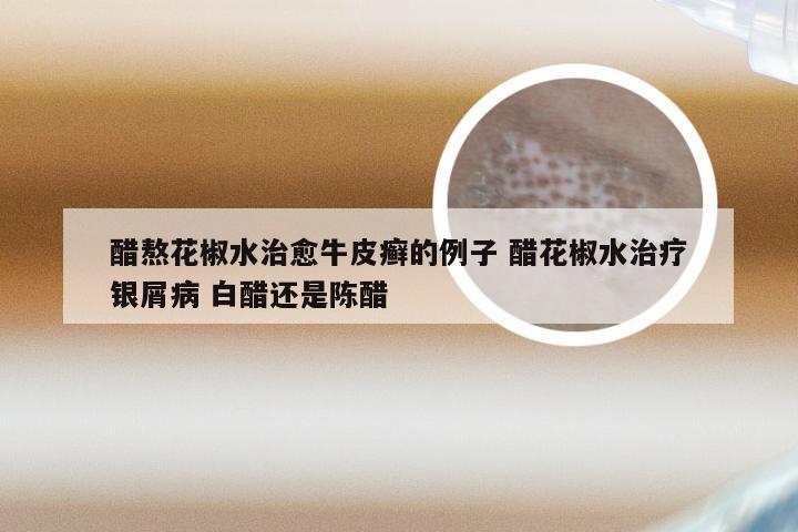醋熬花椒水治愈牛皮癣的例子 醋花椒水治疗银屑病 白醋还是陈醋