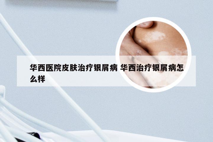 华西医院皮肤治疗银屑病 华西治疗银屑病怎么样