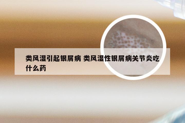 类风湿引起银屑病 类风湿性银屑病关节炎吃什么药
