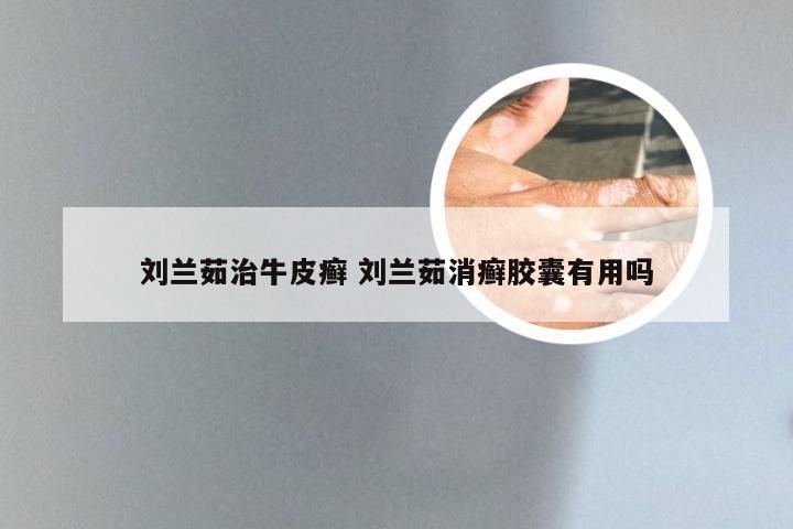 刘兰茹治牛皮癣 刘兰茹消癣胶囊有用吗