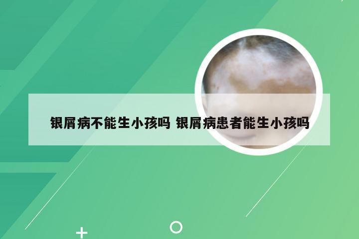 银屑病不能生小孩吗 银屑病患者能生小孩吗