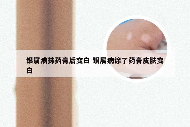 银屑病抹药膏后变白 银屑病涂了药膏皮肤变白
