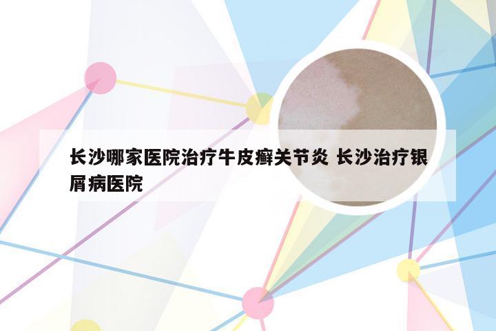 长沙哪家医院治疗牛皮癣关节炎 长沙治疗银屑病医院