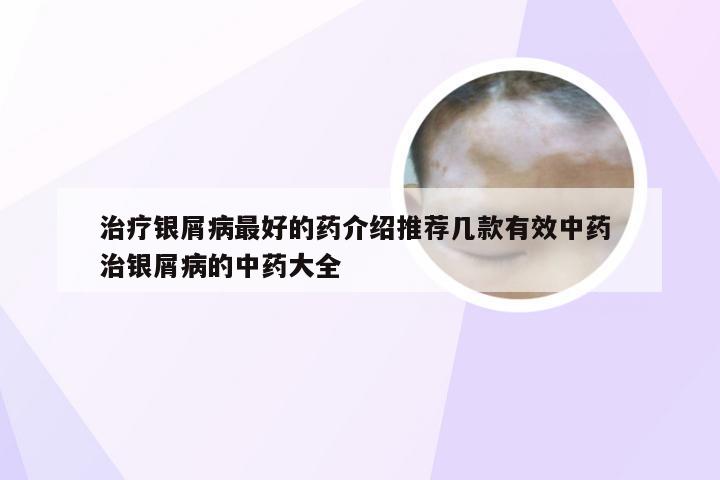 治疗银屑病最好的药介绍推荐几款有效中药 治银屑病的中药大全