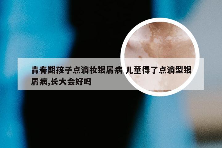 青春期孩子点滴妆银屑病 儿童得了点滴型银屑病,长大会好吗