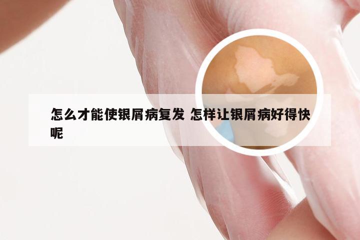 怎么才能使银屑病复发 怎样让银屑病好得快呢