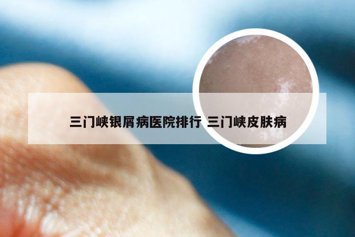 三门峡银屑病医院排行 三门峡皮肤病