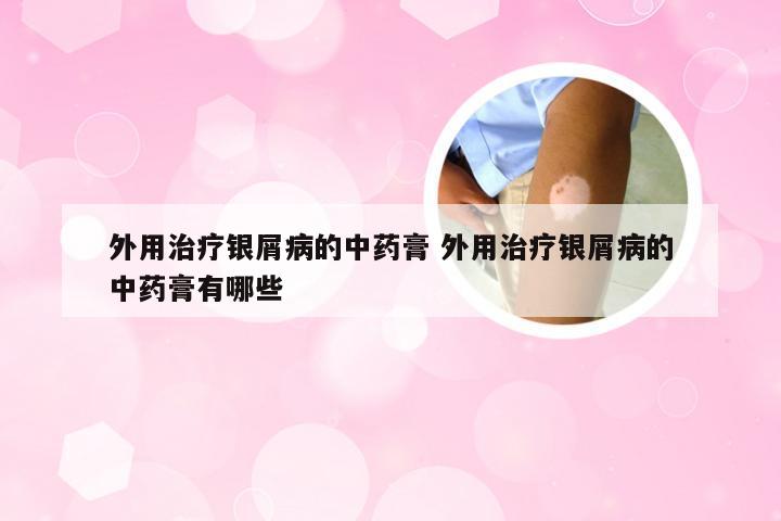 外用治疗银屑病的中药膏 外用治疗银屑病的中药膏有哪些