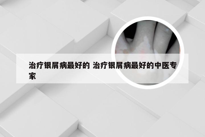 治疗银屑病最好的 治疗银屑病最好的中医专家