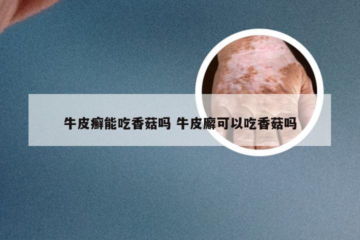 牛皮癣能吃香菇吗 牛皮廨可以吃香菇吗