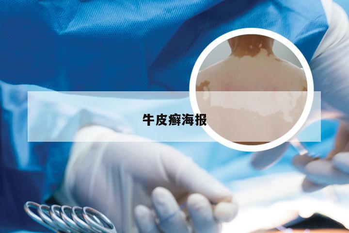 牛皮癣海报
