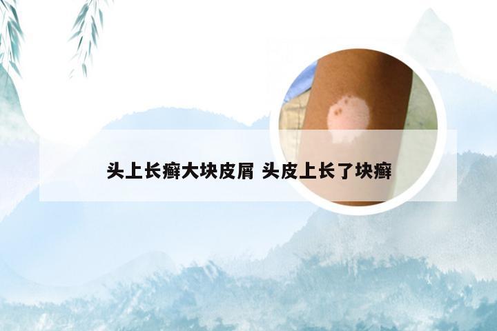 头上长癣大块皮屑 头皮上长了块癣