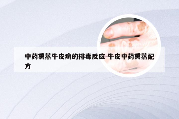 中药熏蒸牛皮癣的排毒反应 牛皮中药熏蒸配方