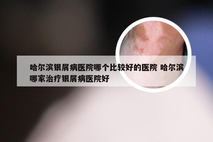 哈尔滨银屑病医院哪个比较好的医院 哈尔滨哪家治疗银屑病医院好