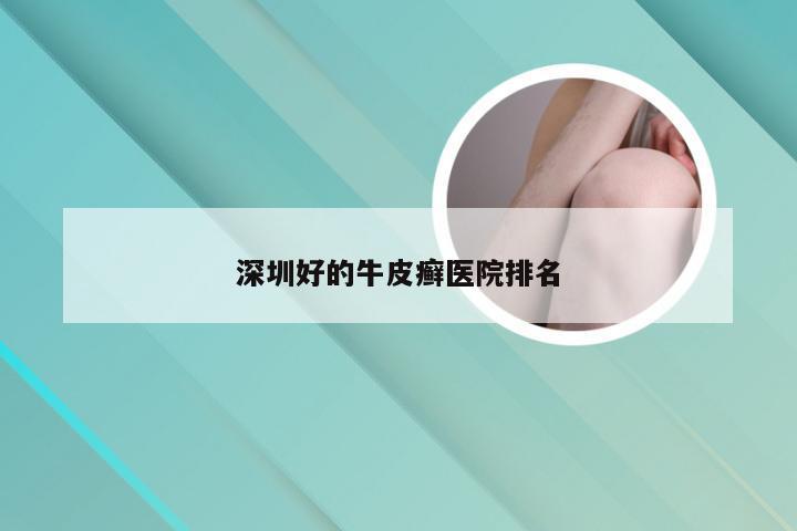 深圳好的牛皮癣医院排名