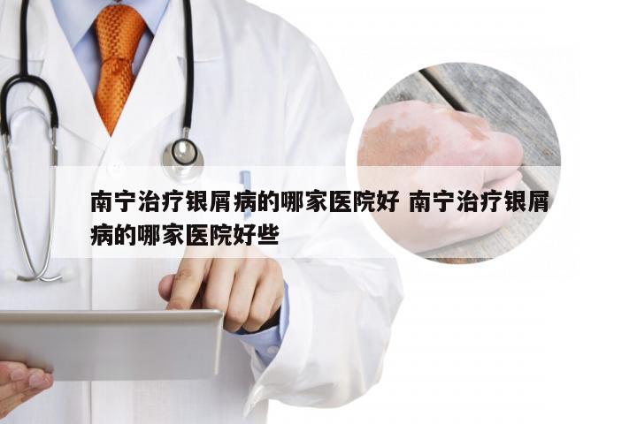 南宁治疗银屑病的哪家医院好 南宁治疗银屑病的哪家医院好些