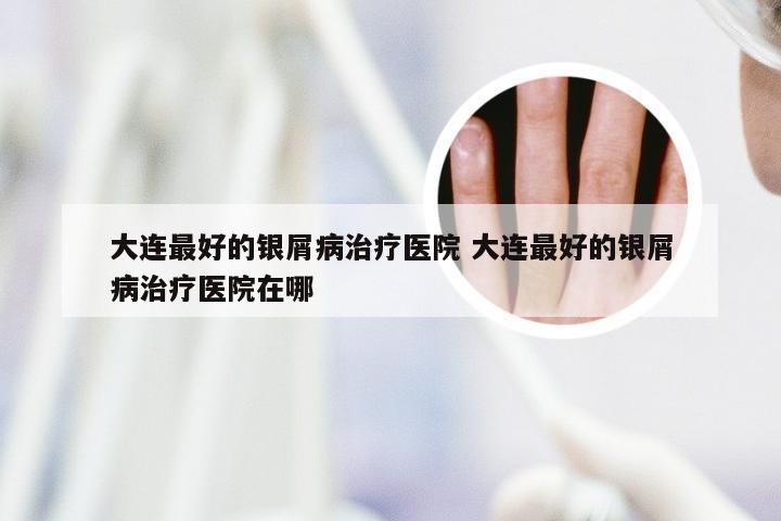 大连最好的银屑病治疗医院 大连最好的银屑病治疗医院在哪