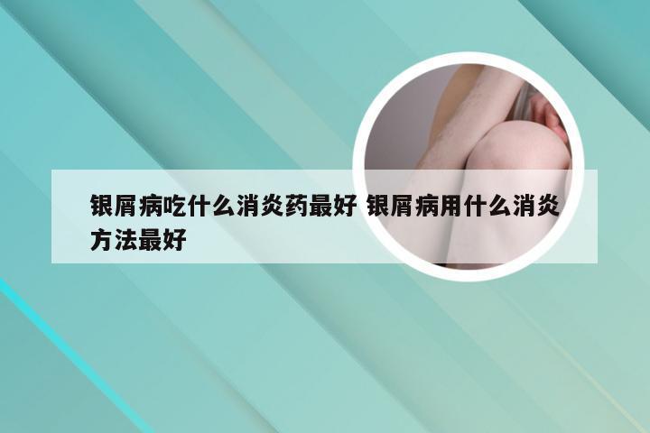 银屑病吃什么消炎药最好 银屑病用什么消炎方法最好