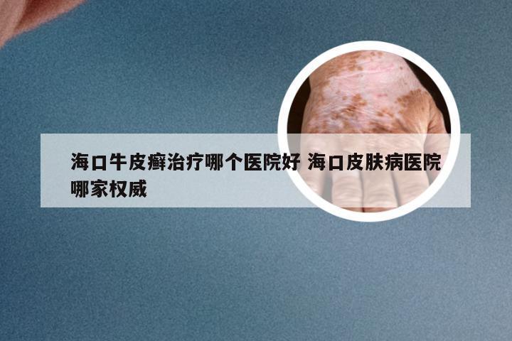 海口牛皮癣治疗哪个医院好 海口皮肤病医院哪家权威