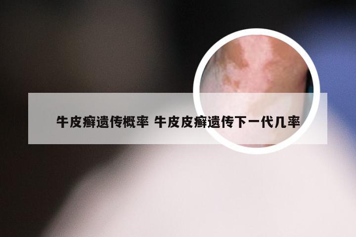 牛皮癣遗传概率 牛皮皮癣遗传下一代几率