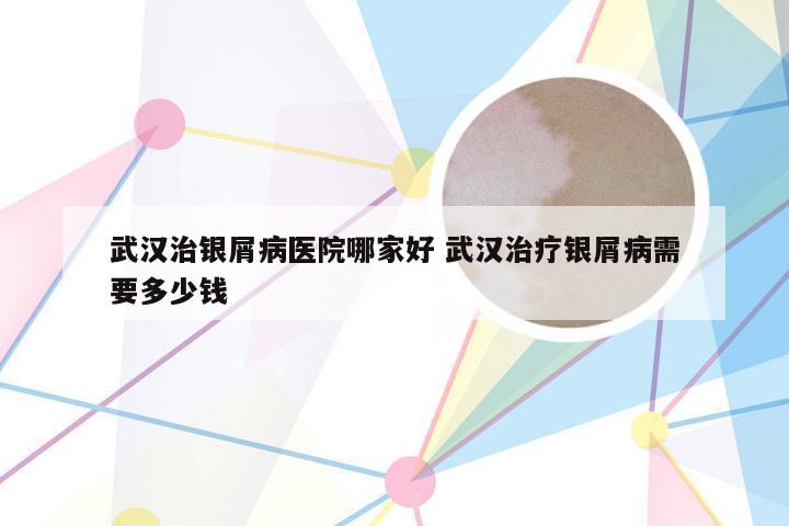 武汉治银屑病医院哪家好 武汉治疗银屑病需要多少钱