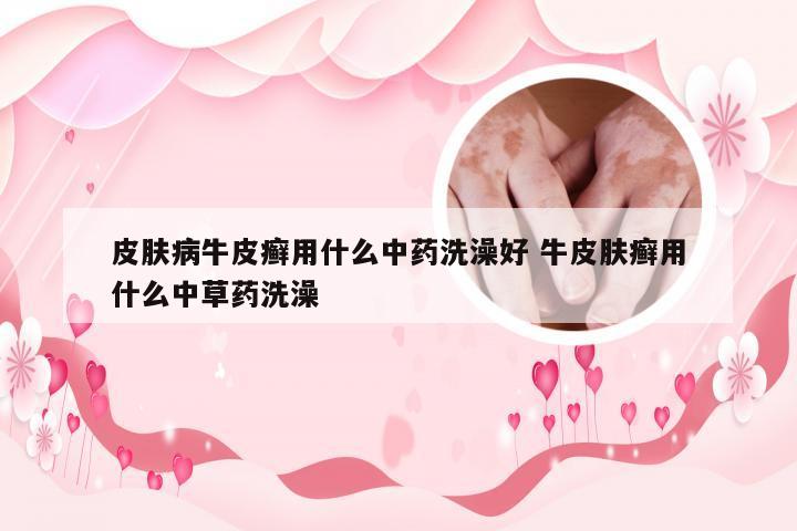 皮肤病牛皮癣用什么中药洗澡好 牛皮肤癣用什么中草药洗澡