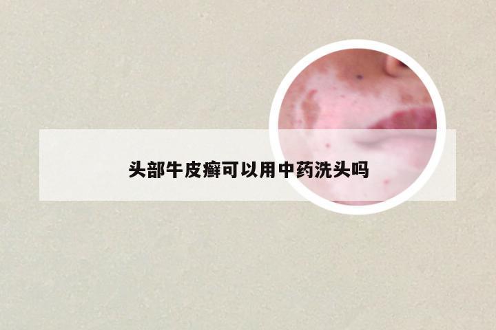 头部牛皮癣可以用中药洗头吗