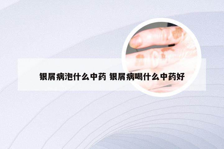 银屑病泡什么中药 银屑病喝什么中药好