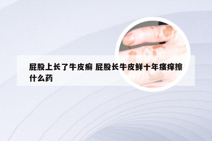 屁股上长了牛皮癣 屁股长牛皮鲜十年瘙痒擦什么药
