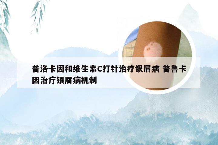 普洛卡因和维生素C打针治疗银屑病 普鲁卡因治疗银屑病机制