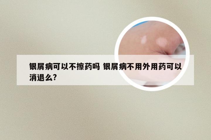 银屑病可以不擦药吗 银屑病不用外用药可以消退么?