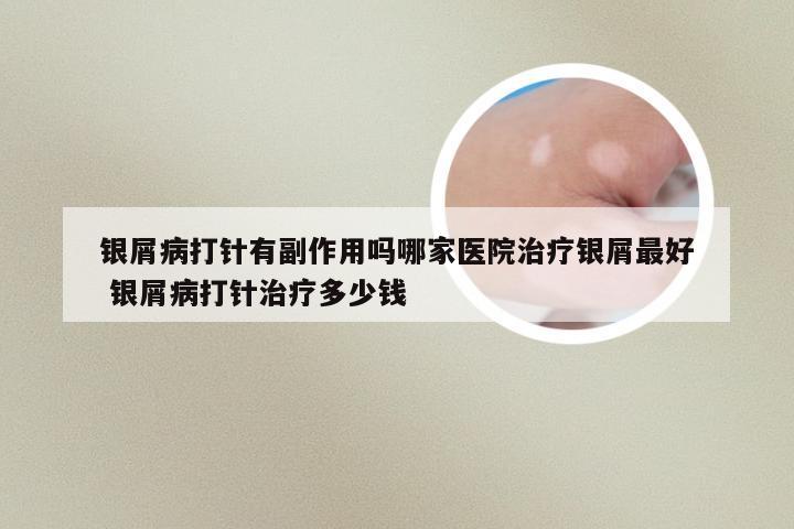 银屑病打针有副作用吗哪家医院治疗银屑最好 银屑病打针治疗多少钱