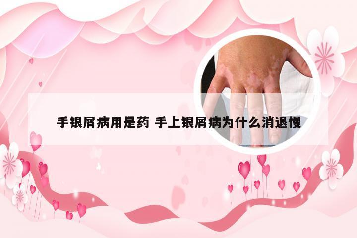 手银屑病用是药 手上银屑病为什么消退慢