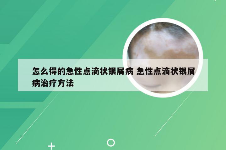 怎么得的急性点滴状银屑病 急性点滴状银屑病治疗方法