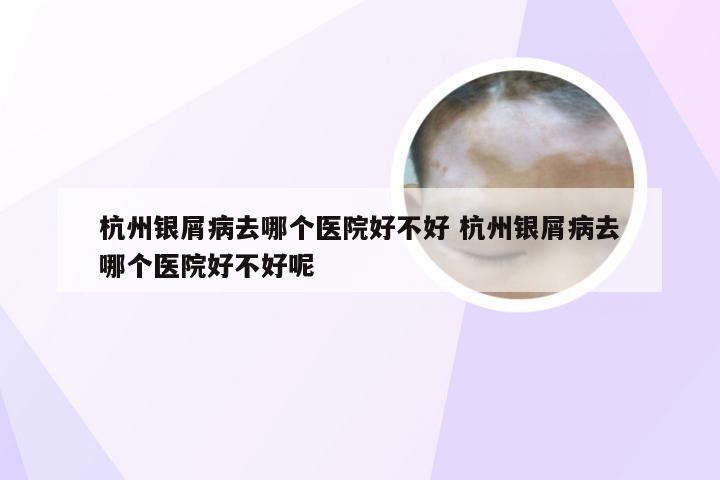杭州银屑病去哪个医院好不好 杭州银屑病去哪个医院好不好呢