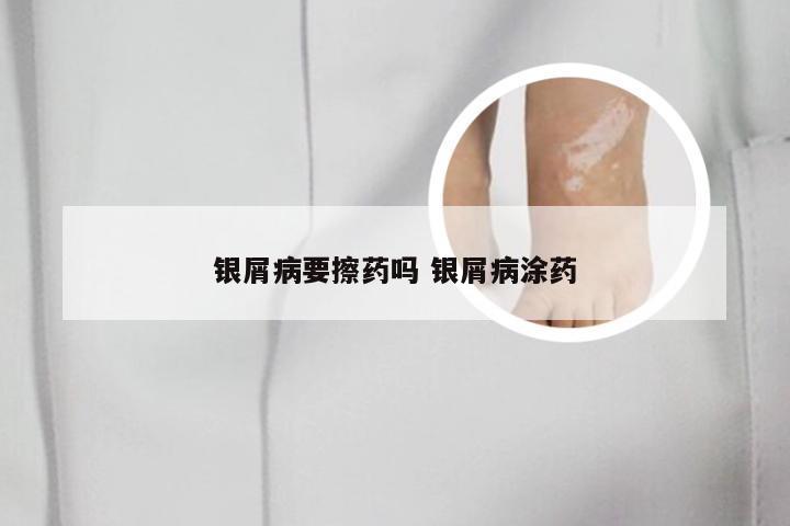 银屑病要擦药吗 银屑病涂药