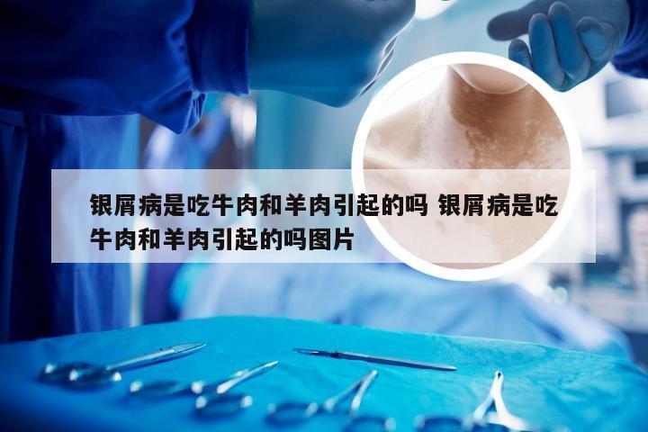 银屑病是吃牛肉和羊肉引起的吗 银屑病是吃牛肉和羊肉引起的吗图片