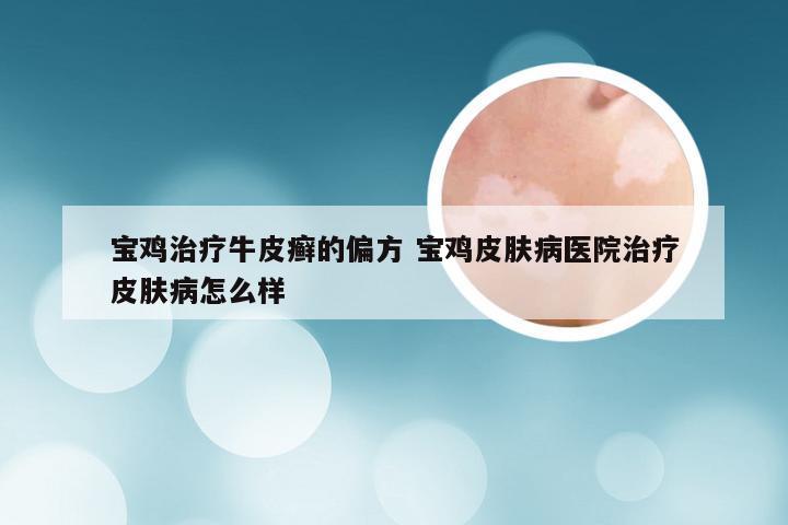 宝鸡治疗牛皮癣的偏方 宝鸡皮肤病医院治疗皮肤病怎么样