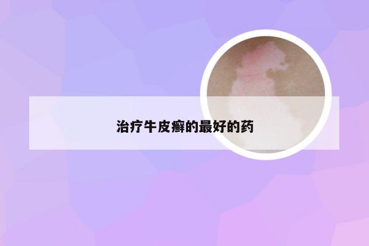治疗牛皮癣的最好的药