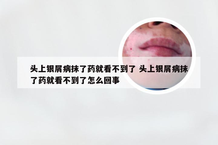 头上银屑病抹了药就看不到了 头上银屑病抹了药就看不到了怎么回事
