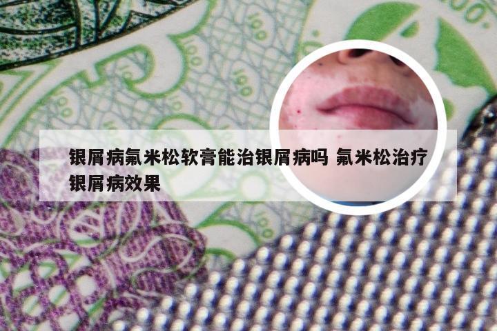 银屑病氟米松软膏能治银屑病吗 氟米松治疗银屑病效果