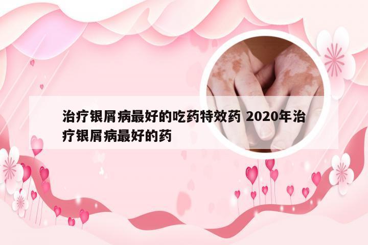 治疗银屑病最好的吃药特效药 2020年治疗银屑病最好的药