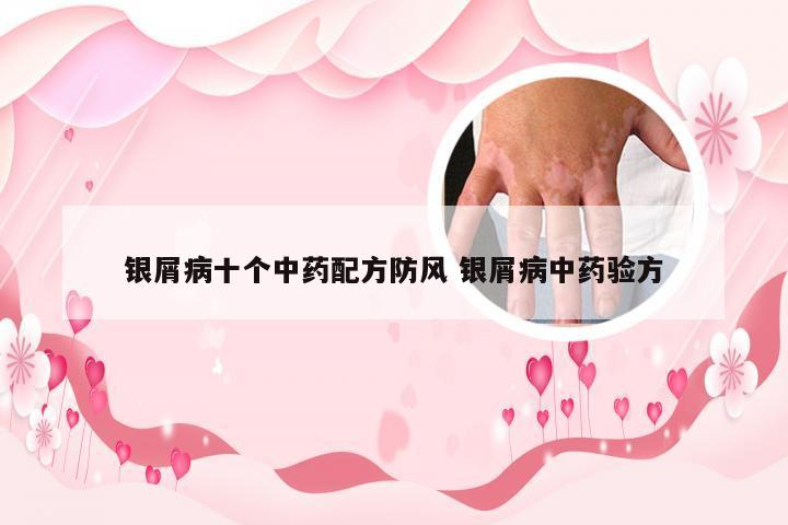 银屑病十个中药配方防风 银屑病中药验方